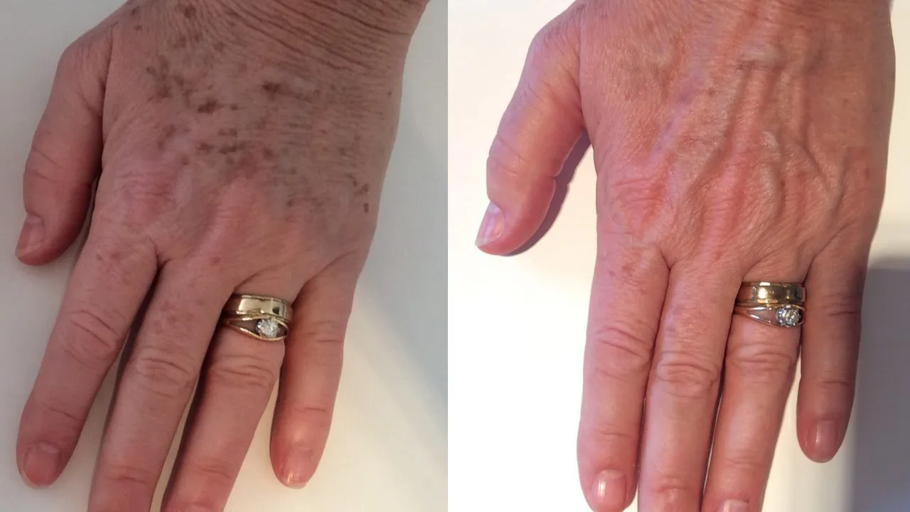 lumecca before after hands