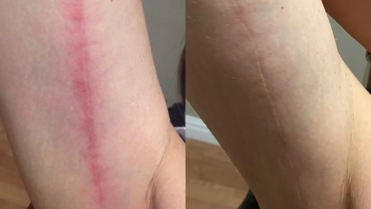 lumecca before after lauren abramowitz rpa c park avenue skin solutions preview 1