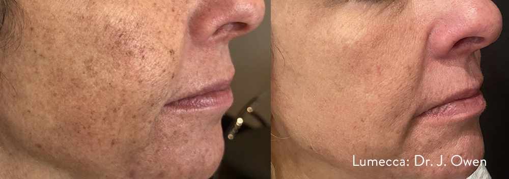 lumecca before after face